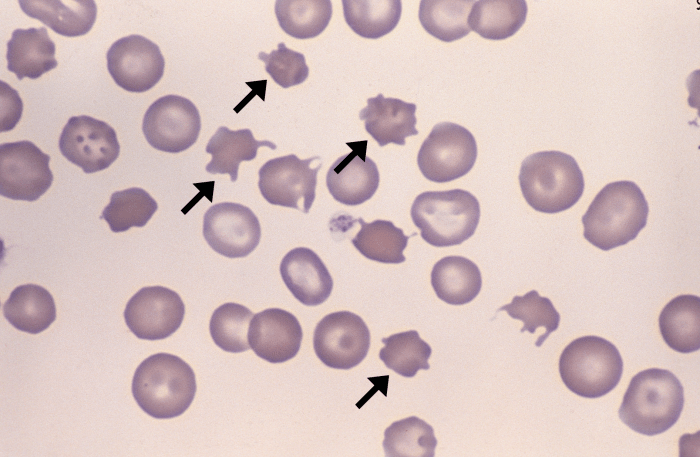 Acanthocytes 1 (Canine - HSA1) ARROWS