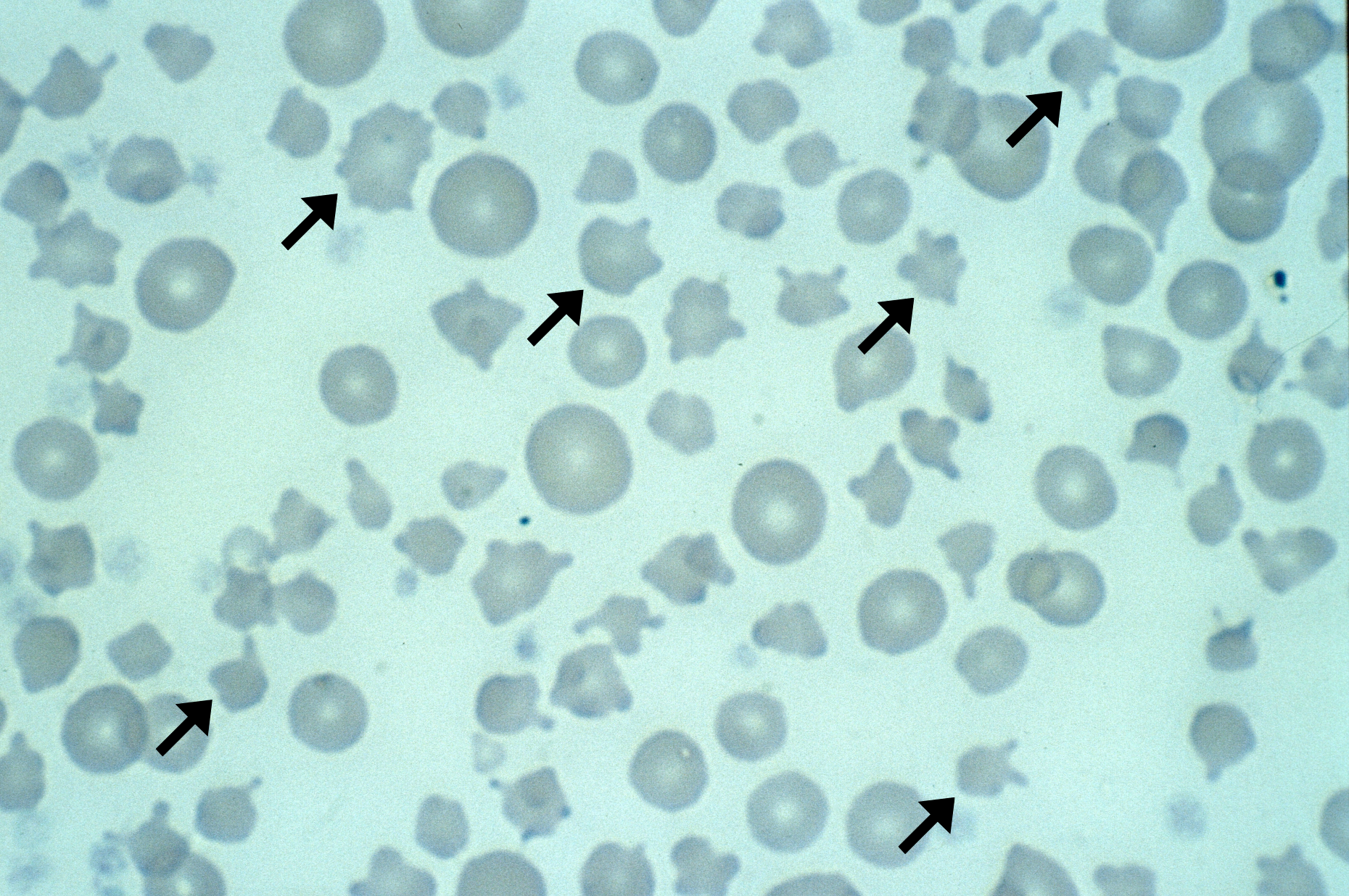Acanthocytes – Cells and Smears