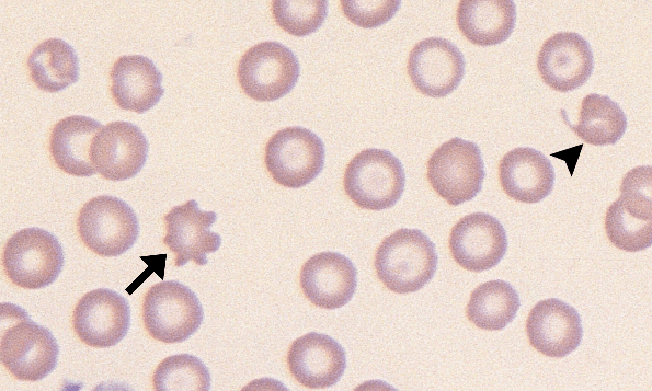 Acanthocytes 6 (Canine 3 - Iron Deficiency) ARROWS