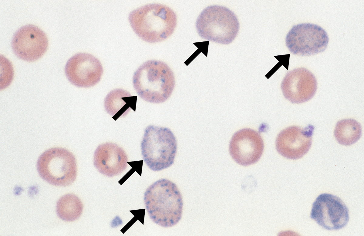 basophilic stippling – Cells and Smears
