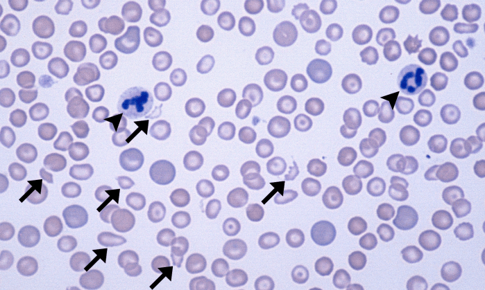 Schizocytes 1 (Canine 1 - DIC) ARROWS