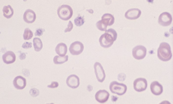 Hypochromasia 2 (Canine 2 - Iron Deficiency)
