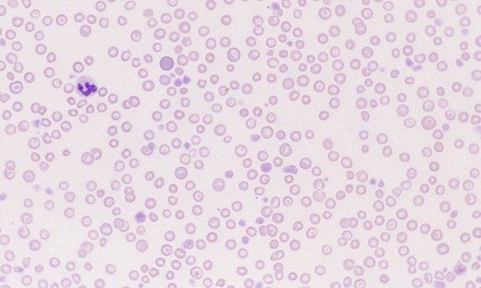 Hypochromasia 4 (Canine 4 - Iron Deficiency)