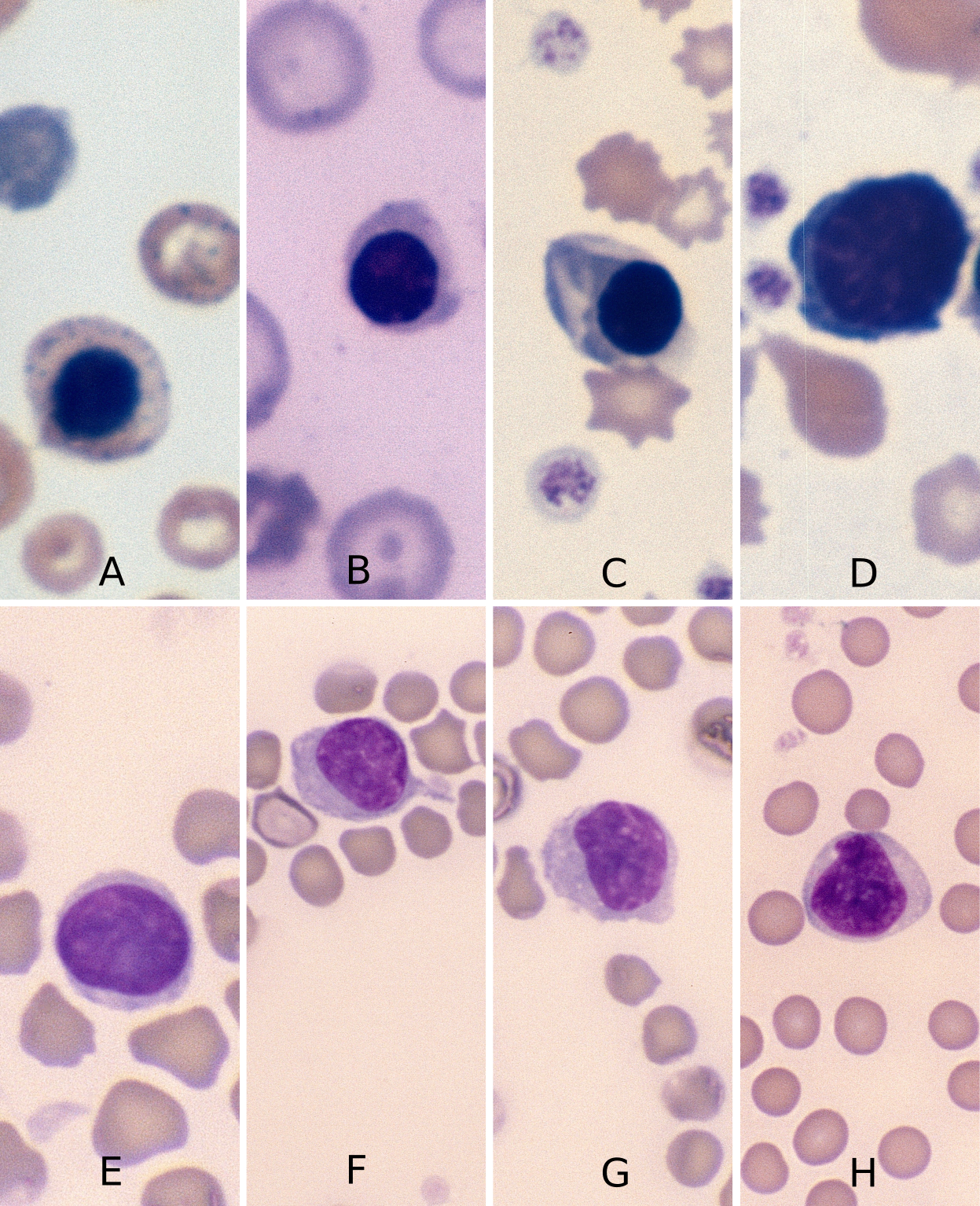 Pknotic Rbc Nucleated Red Blood Cells – Cells and Smears