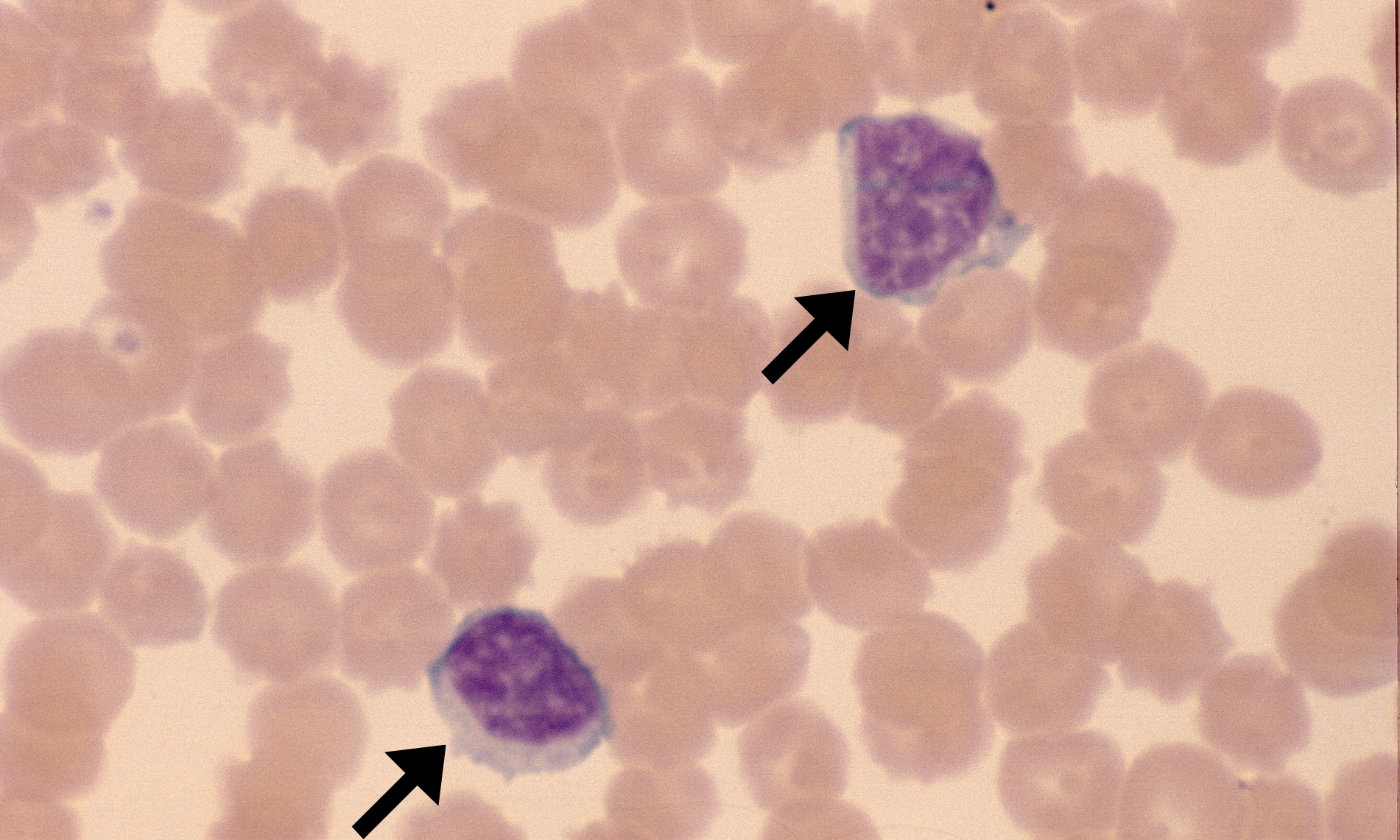 Cll Notes CLL – Cells and Smears
