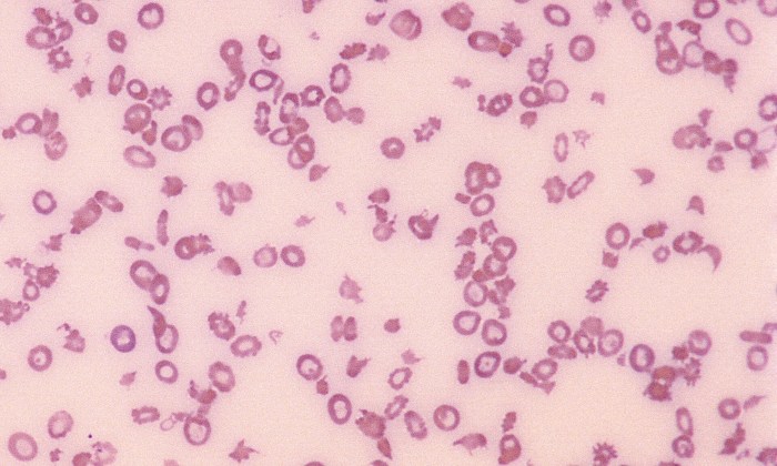 Poikilocytosis 5 (Canine 1 - Splenic Mass)
